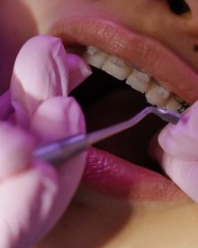 Laser Dentistry: A Way for Painless Dental Procedures Without Anesthesia?